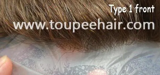 unsichtbarer vorderer Haaransatz Typ 1
